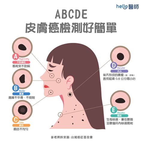 如何避免長痣|痣形成的原因？痣長毛、痣變多變大是痣病變？5招判。